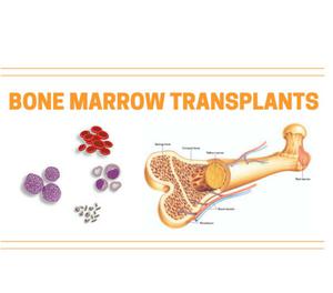 Bone Marrow Transplant guide - Cost Comparision, Complicatio