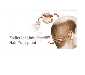 Follicular Unit Transplantation Service Hyderabad