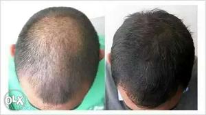 Kirkland minoxidil hair growth