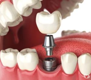 Dental implant services in India | Dental implant in Chennai