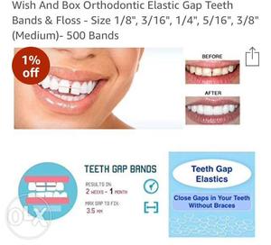 You can avoid braces and use these special bands