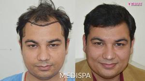Hair Transplant Cost in India