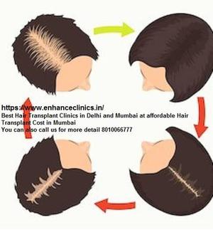 Available good and low cost for fue hair transplant in Delhi