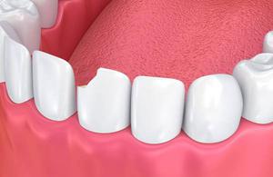 Find Expert Dentists for Broken Tooth Treatment at Best Cost