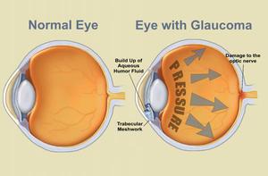 Glaucoma treatment in Pune