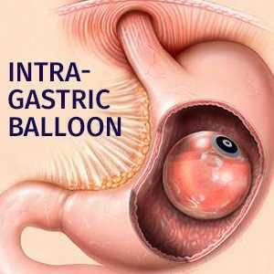 Top Intragastric Balloon Surgery In Pune
