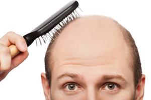 How To Cure Genetic Baldness Permanently?