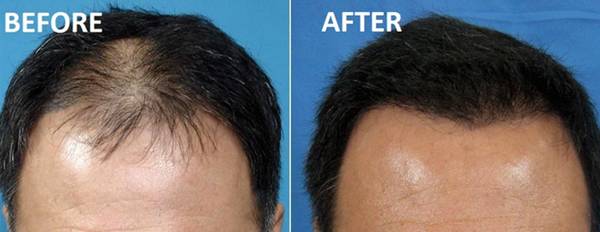 PRP Hair Loss Treatment
