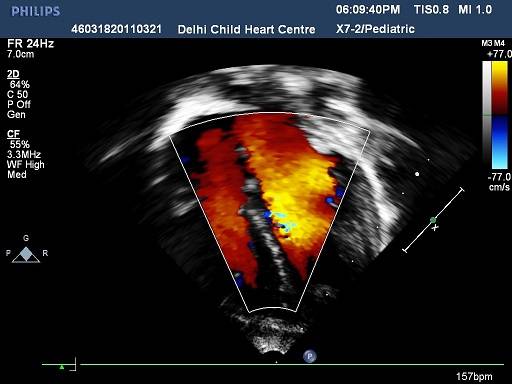 Become Expert in Pediatric Echocardiology