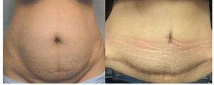Get up to 60% Discount on Tummy Tuck Surgery in Delhi