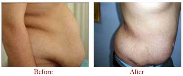 Get up to 60% Discount on Body Lift Surgery in Delhi