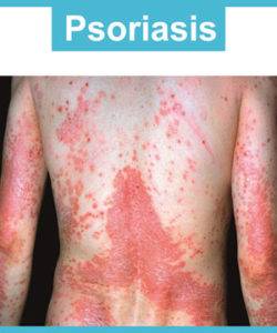 Best Psoriasis Cure Specialist Treatment in Hyderabad