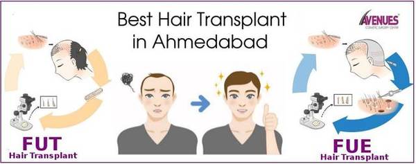 Best Treatment for Hair Loss – Treat Before your Hair Goes