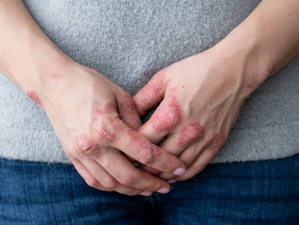 Overcome Psoriasis Problems for Life |Padanjaly Ayurvedics