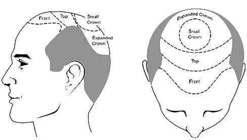 Hair transplant Cost in India - vjclinics