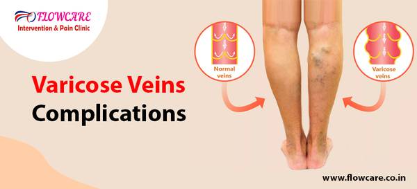 Varicose Veins Doctor with great experience