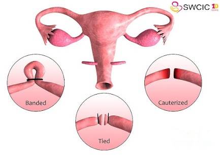infertility treatments