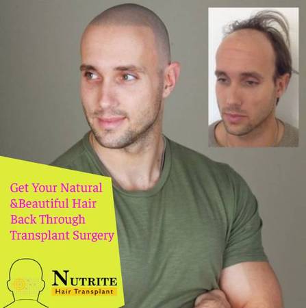 Get Your Natural And Beautiful Hair Back Through Transplant