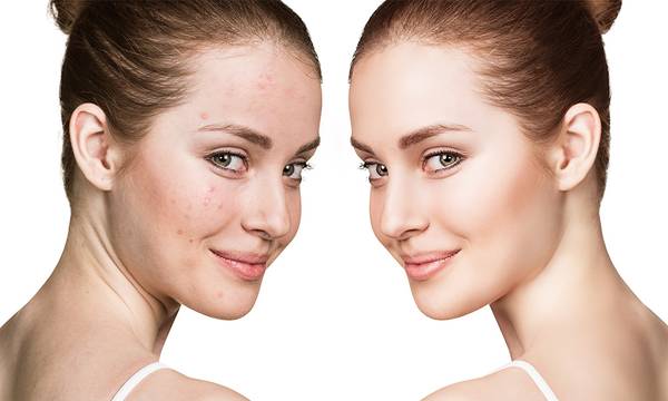 Acne Scar Treatment in Delhi