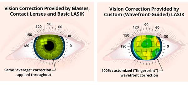 Lasik Surgery Near Me: Vision Eye Centre