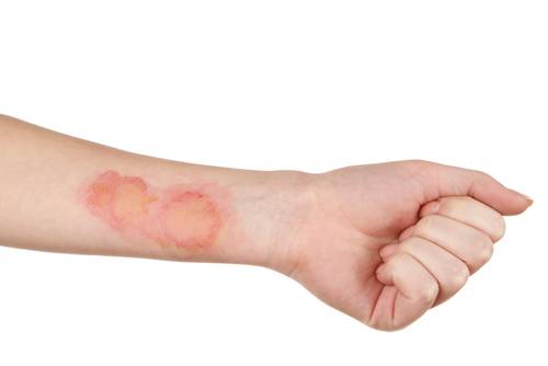 Burns And Scar Treatment Using Ayurveda|Padanjali Ayurvedics