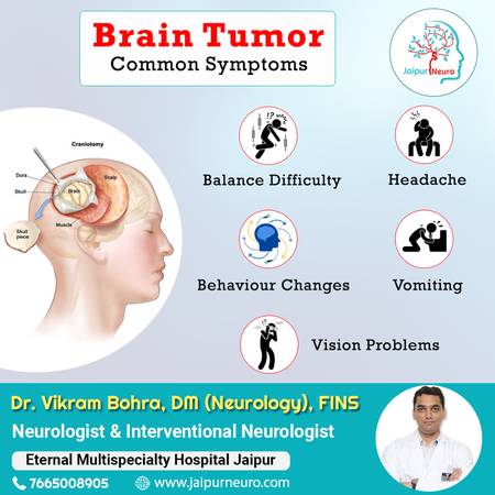 Brain Tumor Common Symptoms