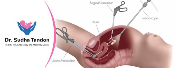 Laparoscopic Hysterectomy in India | Laparoscopic