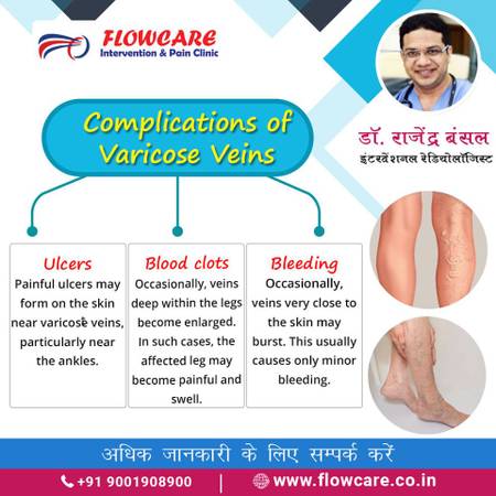 Complications of varicose veins