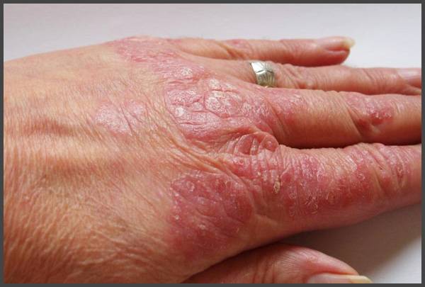 Perfect Treatment That Clears Psoriasis | Padanjali