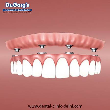 Single Tooth Implant Cost in Delhi