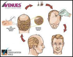 Don’t waste Time Thinking Of Hair Loss And Invest it In