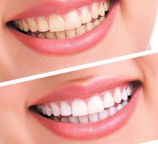 Buy Professional Oral Hygiene Teeth Whitening Gel at Low