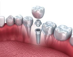 Reasonably Priced Dental Implants in Delhi: Smile Delhi -