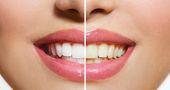 Teeth Whitening in Delhi - Teeth Bleaching - Smile Delhi -