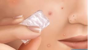 How to Get Rid of Pimples Overnight - Healthie Genie