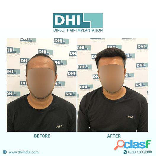 Hair Transplant Cost in Bangalore DHI India