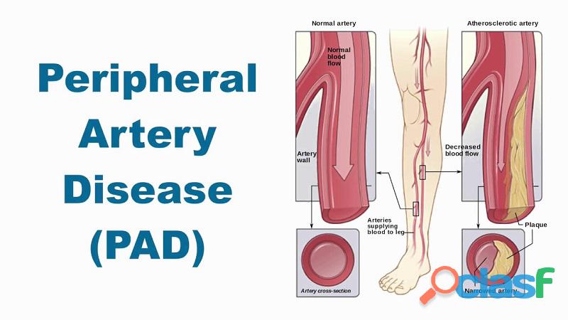 Peripheral Arterial Disease (PAD) : Symptoms & Treatment