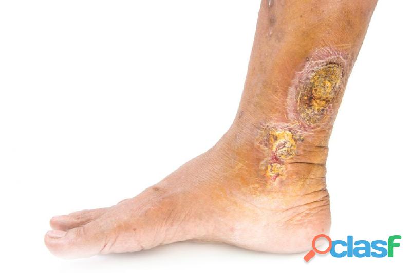 Venous Leg Ulcers – Know The Vital Risk Factors