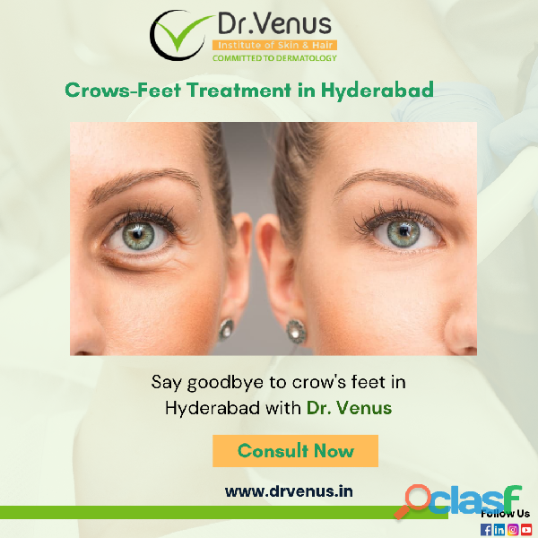Crows Feet Treatment in Hyderabad